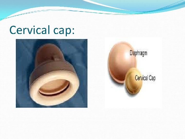 Cervical cap: 