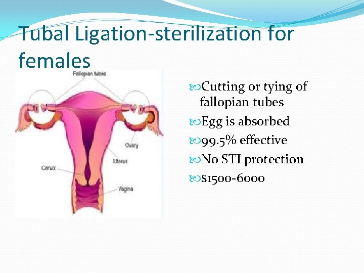 Tubal Ligation-sterilization for females Cutting or tying of fallopian tubes Egg is absorbed 99.