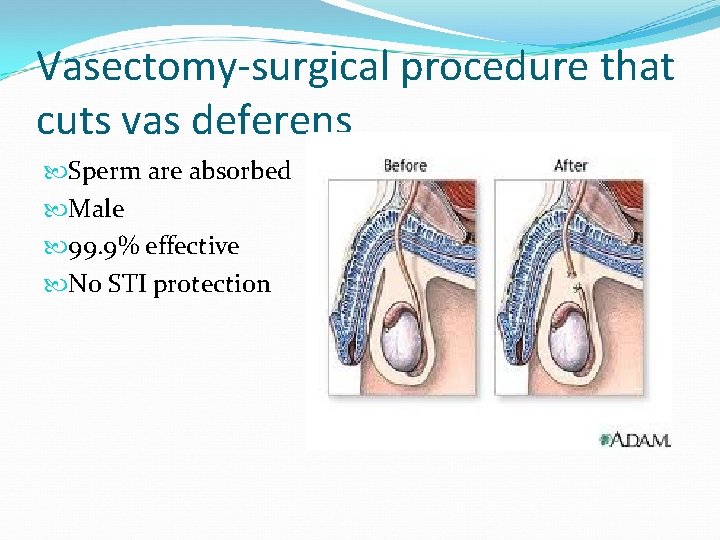 Vasectomy-surgical procedure that cuts vas deferens Sperm are absorbed Male 99. 9% effective No