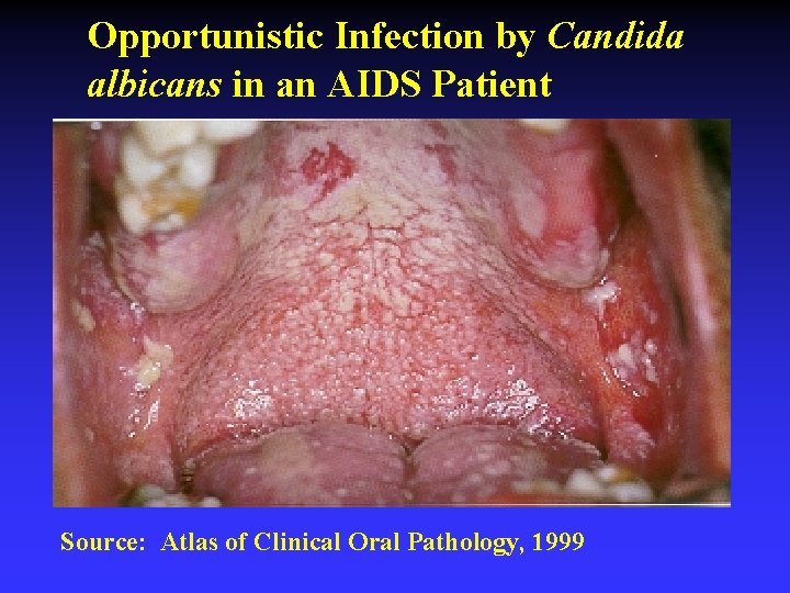 Opportunistic Infection by Candida albicans in an AIDS Patient Source: Atlas of Clinical Oral
