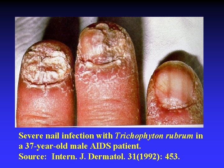 Severe nail infection with Trichophyton rubrum in a 37 -year-old male AIDS patient. Source: