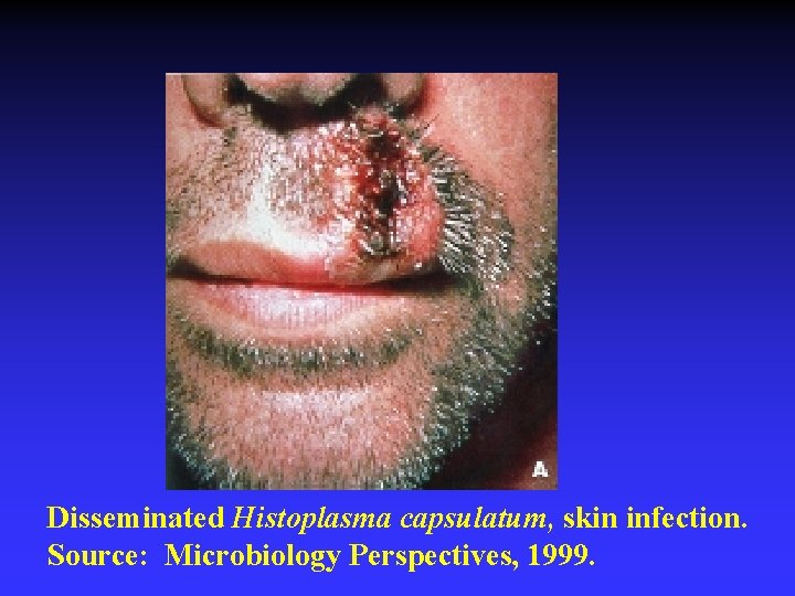 Disseminated Histoplasma capsulatum, skin infection. Source: Microbiology Perspectives, 1999. 