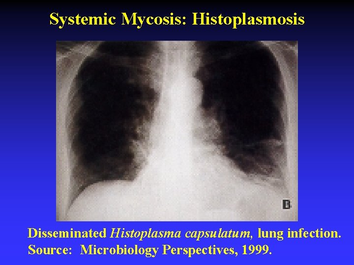 Systemic Mycosis: Histoplasmosis Disseminated Histoplasma capsulatum, lung infection. Source: Microbiology Perspectives, 1999. 