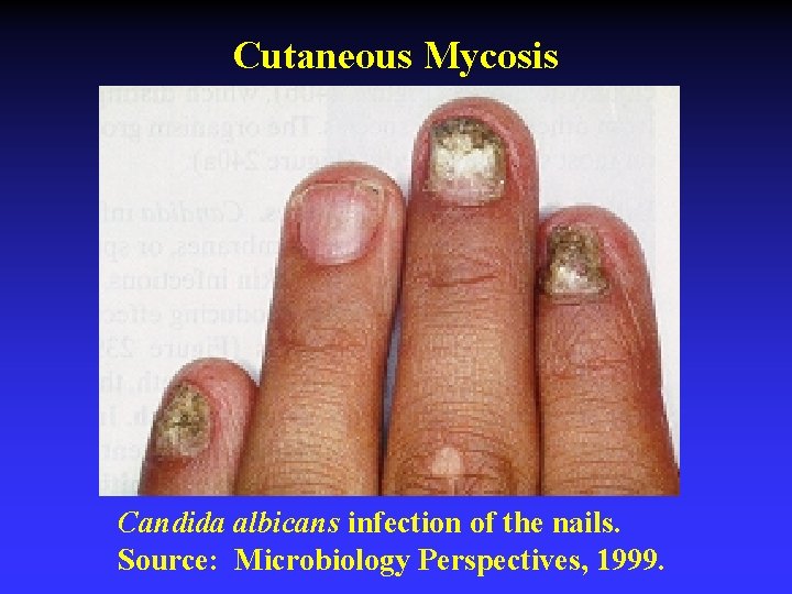Cutaneous Mycosis Candida albicans infection of the nails. Source: Microbiology Perspectives, 1999. 