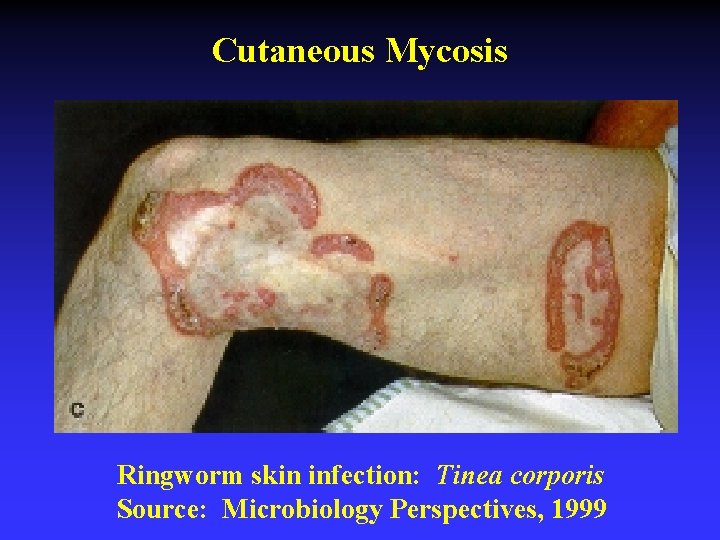 Cutaneous Mycosis Ringworm skin infection: Tinea corporis Source: Microbiology Perspectives, 1999 