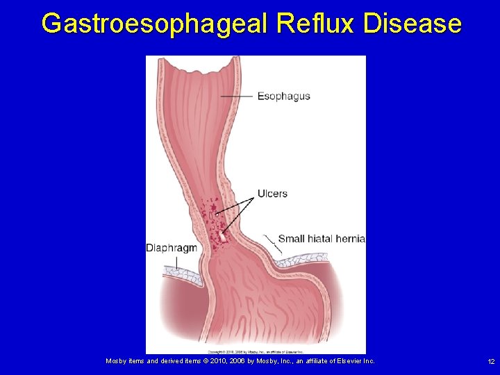 Gastroesophageal Reflux Disease Mosby items and derived items © 2010, 2006 by Mosby, Inc.