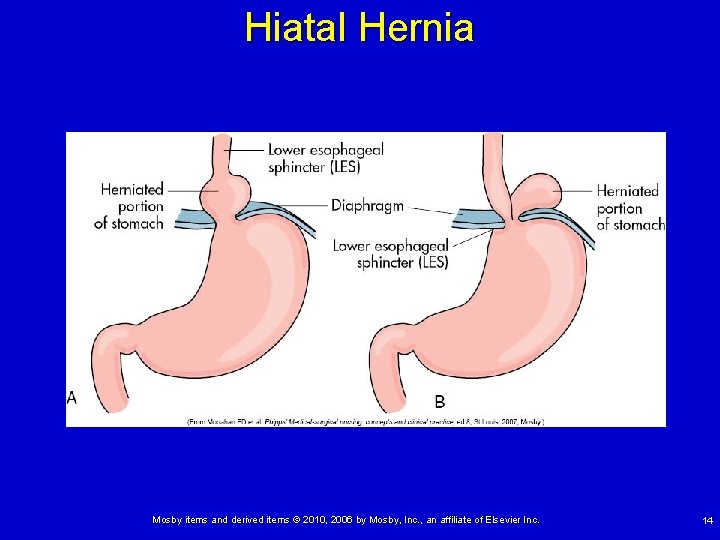 Hiatal Hernia Mosby items and derived items © 2010, 2006 by Mosby, Inc. ,