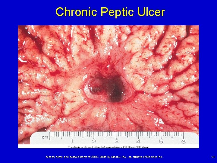 Chronic Peptic Ulcer Mosby items and derived items © 2010, 2006 by Mosby, Inc.