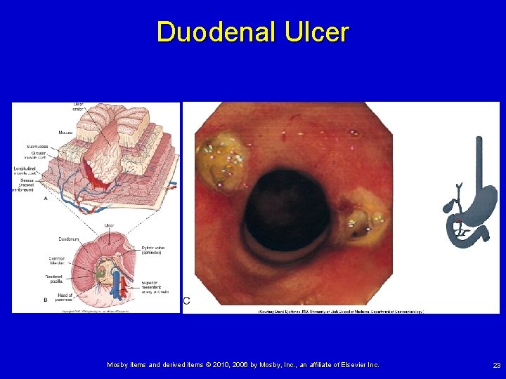 Duodenal Ulcer Mosby items and derived items © 2010, 2006 by Mosby, Inc. ,