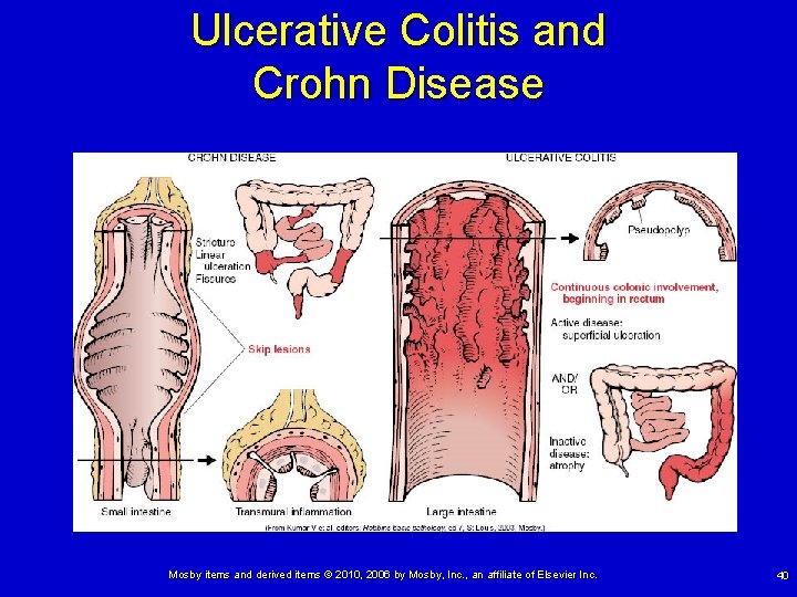 Ulcerative Colitis and Crohn Disease Mosby items and derived items © 2010, 2006 by