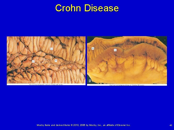 Crohn Disease Mosby items and derived items © 2010, 2006 by Mosby, Inc. ,