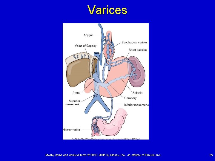 Varices Mosby items and derived items © 2010, 2006 by Mosby, Inc. , an