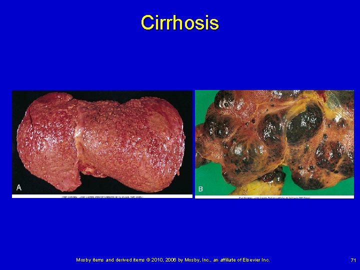 Cirrhosis Mosby items and derived items © 2010, 2006 by Mosby, Inc. , an