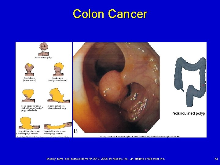 Colon Cancer Mosby items and derived items © 2010, 2006 by Mosby, Inc. ,