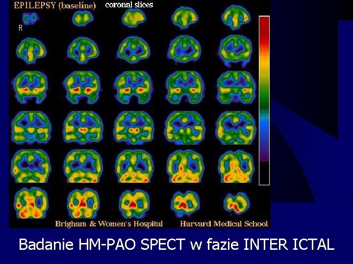 Badanie HM-PAO SPECT w fazie INTER ICTAL 