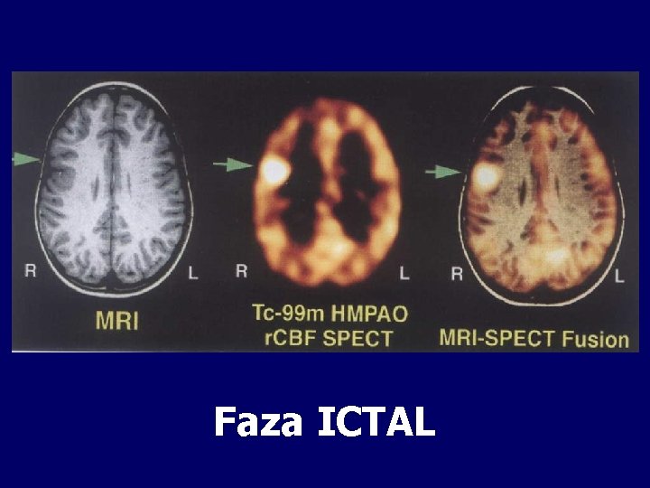 Faza ICTAL 