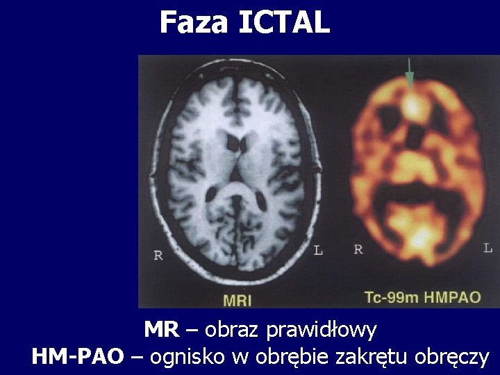 Faza ICTAL MR – obraz prawidłowy HM-PAO – ognisko w obrębie zakrętu obręczy 