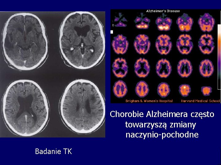 Chorobie Alzheimera często towarzyszą zmiany naczynio-pochodne Badanie TK 