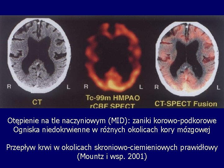 Otępienie na tle naczyniowym (MID): zaniki korowo-podkorowe Ogniska niedokrwienne w różnych okolicach kory mózgowej