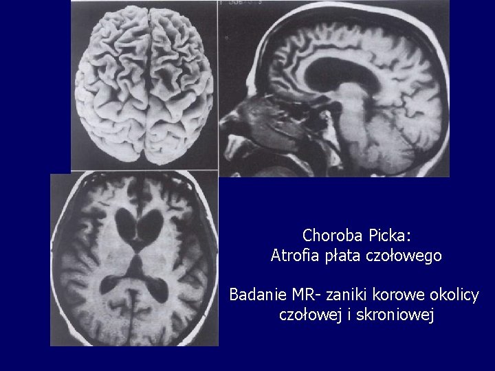 Choroba Picka: Atrofia płata czołowego Badanie MR- zaniki korowe okolicy czołowej i skroniowej 