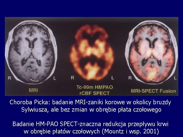 Choroba Picka: badanie MRI-zaniki korowe w okolicy bruzdy Sylwiusza, ale bez zmian w obrębie