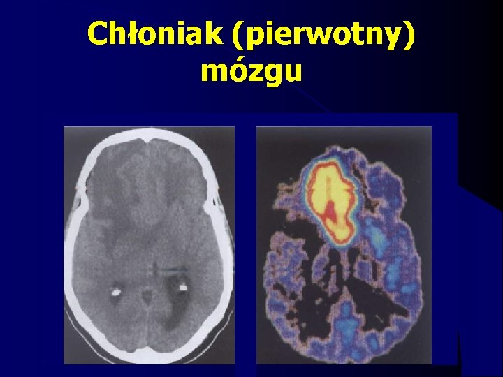 Chłoniak (pierwotny) mózgu 