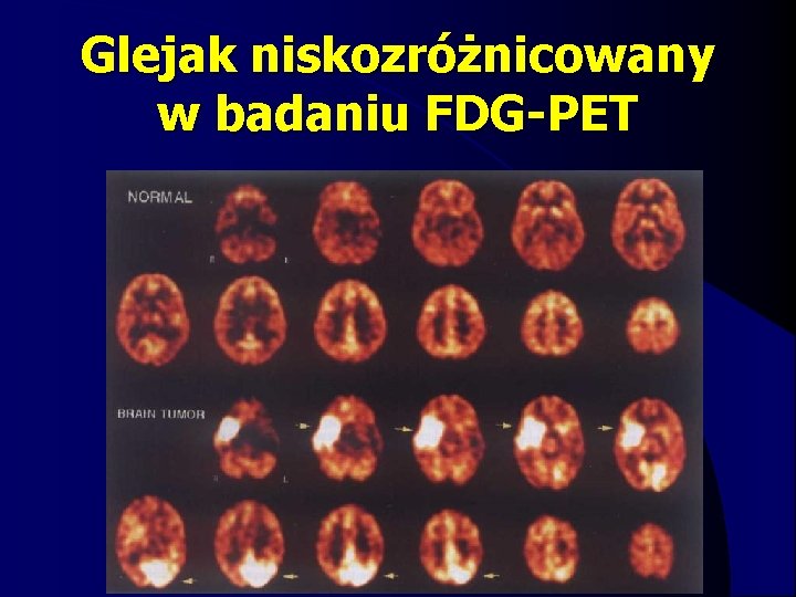 Glejak niskozróżnicowany w badaniu FDG-PET 