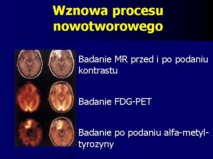 Wznowa procesu nowotworowego Badanie MR przed i po podaniu kontrastu Badanie FDG-PET Badanie po