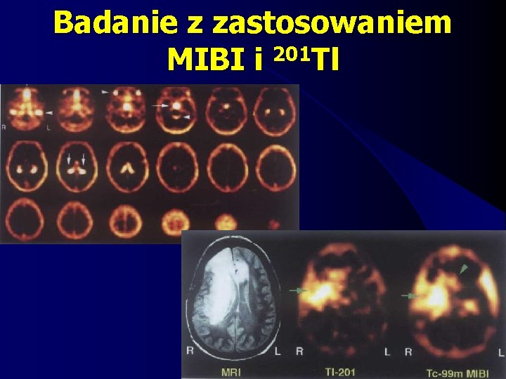 Badanie z zastosowaniem 201 MIBI i Tl 