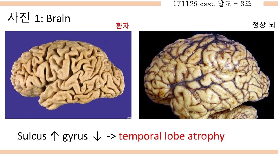 171129 case 발표 - 3조 사진 1: Brain 환자 Sulcus ↑ gyrus ↓ ->