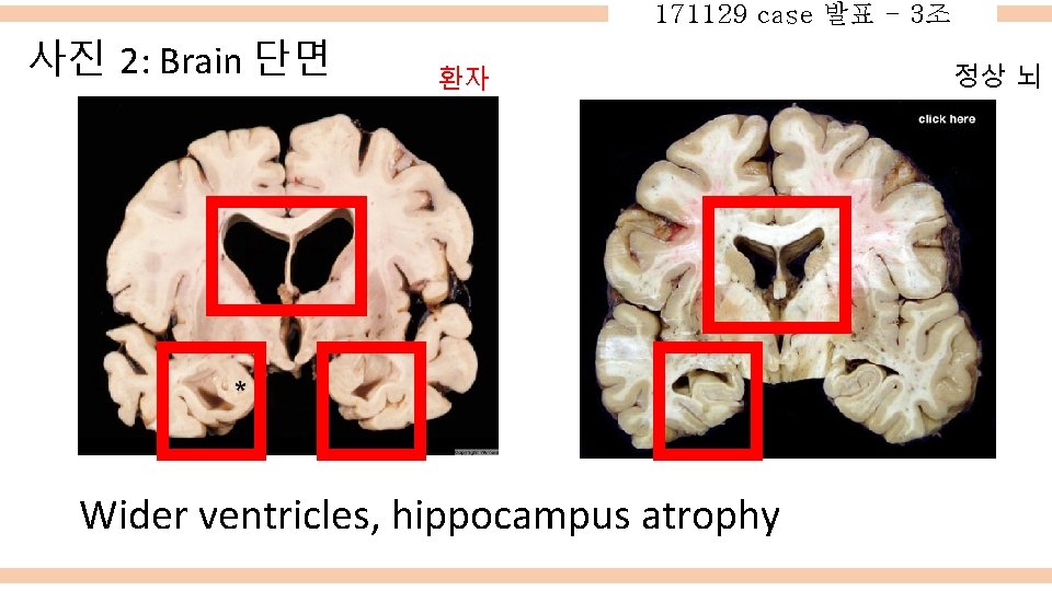 171129 case 발표 - 3조 사진 2: Brain 단면 환자 Wider ventricles, hippocampus atrophy
