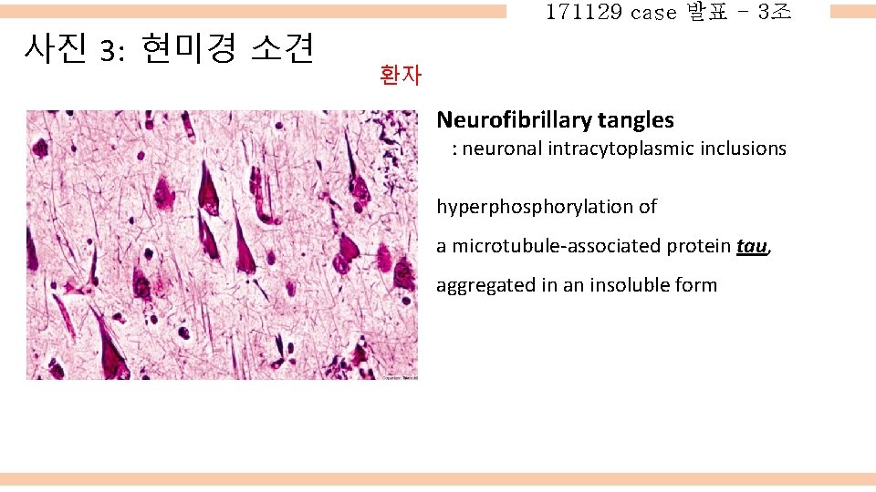 171129 case 발표 - 3조 사진 3: 현미경 소견 환자 Neurofibrillary tangles : neuronal