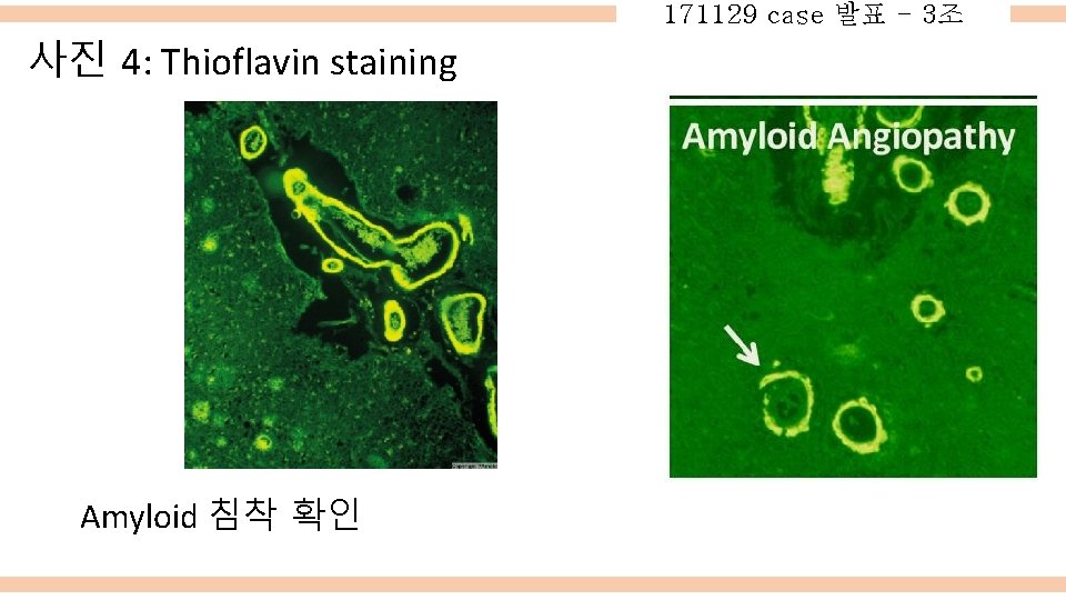 171129 case 발표 - 3조 사진 4: Thioflavin staining Amyloid 침착 확인 