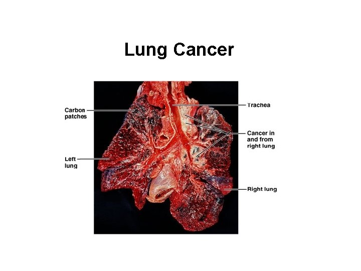 Lung Cancer Copyright © 2007 Pearson Education, Inc. , publishing as Benjamin Cummings 