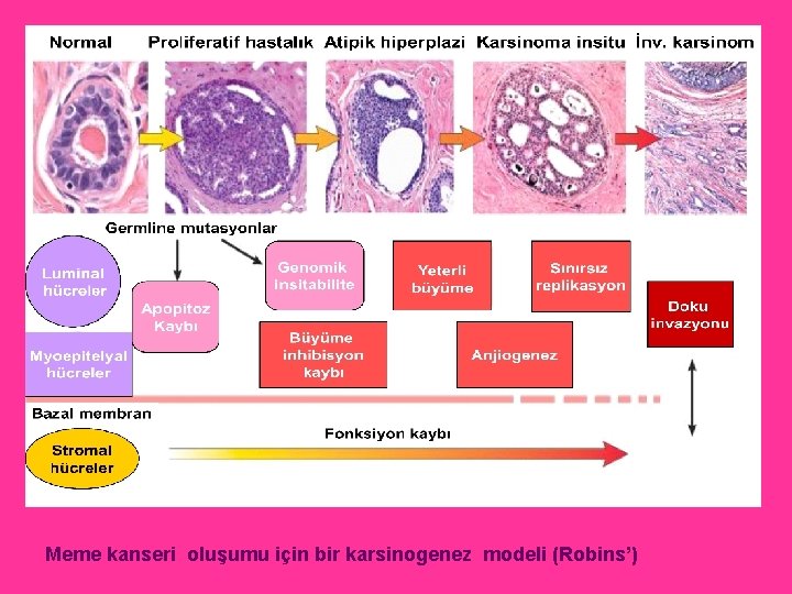 Meme kanseri oluşumu için bir karsinogenez modeli (Robins’) 