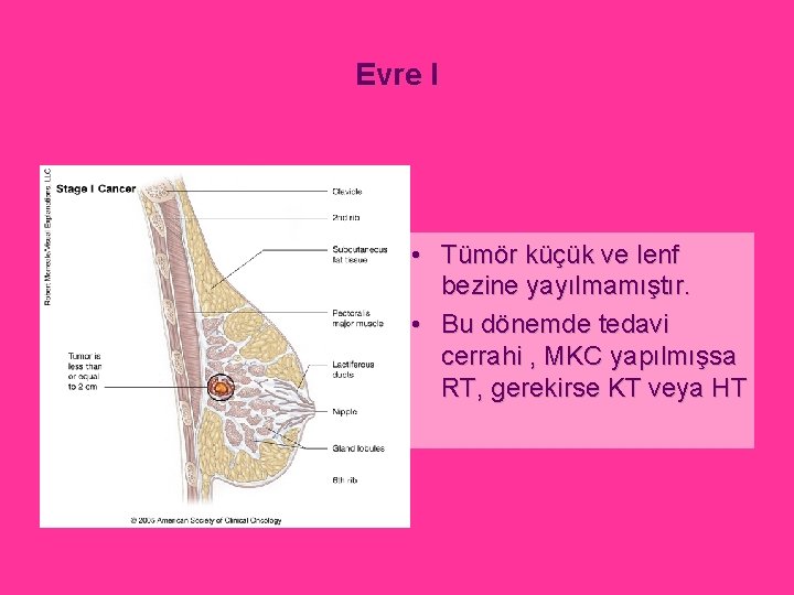 Evre I • Tümör küçük ve lenf bezine yayılmamıştır. • Bu dönemde tedavi cerrahi