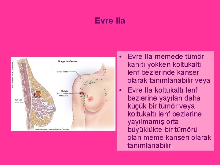 Evre IIa • Evre IIa memede tümör kanıtı yokken koltukaltı lenf bezlerinde kanser olarak