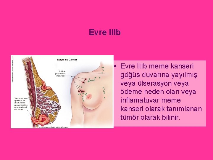 Evre IIIb • Evre IIIb meme kanseri göğüs duvarına yayılmış veya ülserasyon veya ödeme