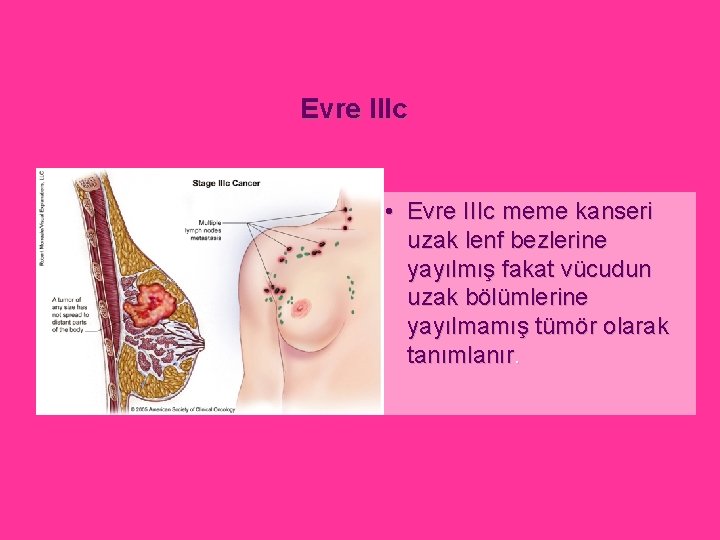 Evre IIIc • Evre IIIc meme kanseri uzak lenf bezlerine yayılmış fakat vücudun uzak