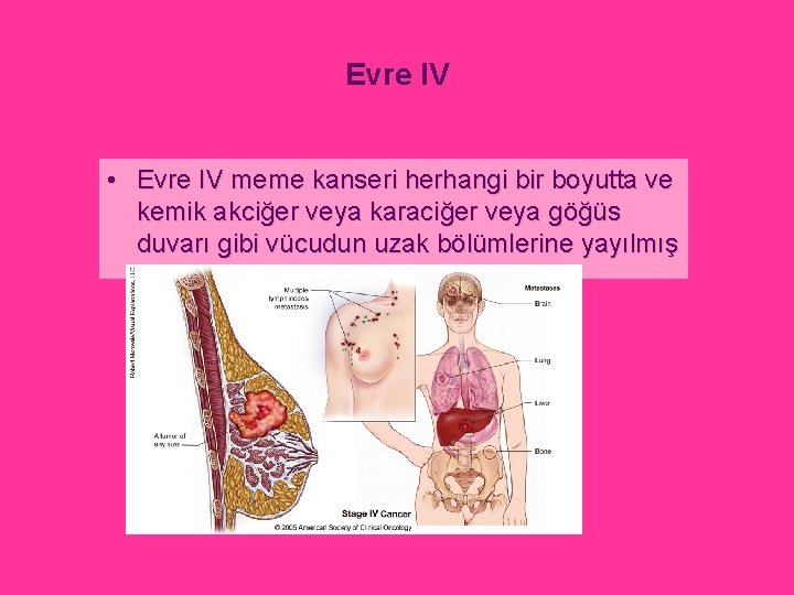 Evre IV • Evre IV meme kanseri herhangi bir boyutta ve kemik akciğer veya