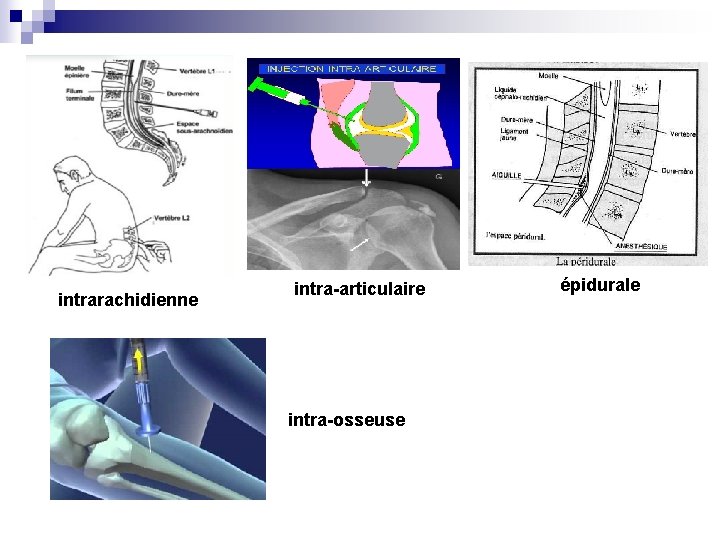 intrarachidienne intra-articulaire intra-osseuse épidurale 