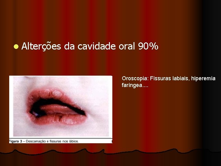 l Alterções da cavidade oral 90% Oroscopia: Fissuras labiais, hiperemia faríngea. . 