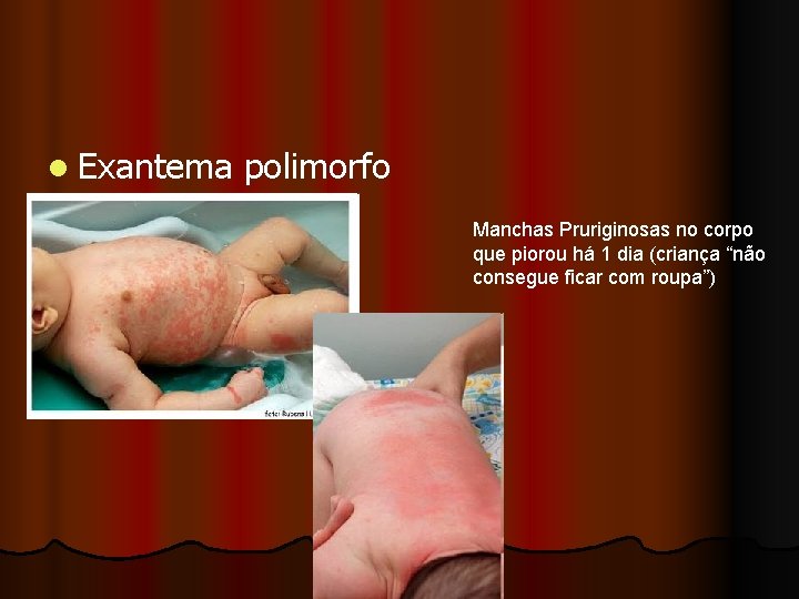 l Exantema polimorfo Manchas Pruriginosas no corpo que piorou há 1 dia (criança “não