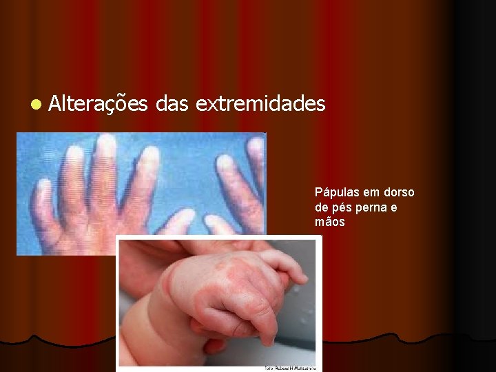 l Alterações das extremidades Pápulas em dorso de pés perna e mãos 