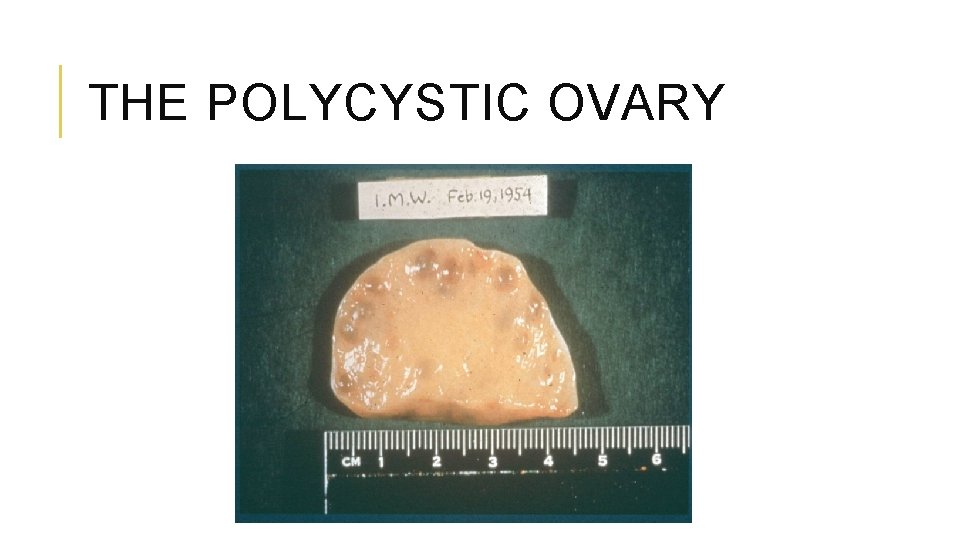 THE POLYCYSTIC OVARY 