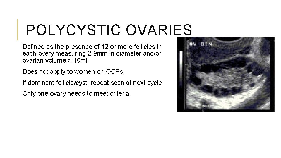 POLYCYSTIC OVARIES Defined as the presence of 12 or more follicles in each overy