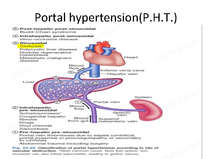Portal hypertension(P. H. T. ) 