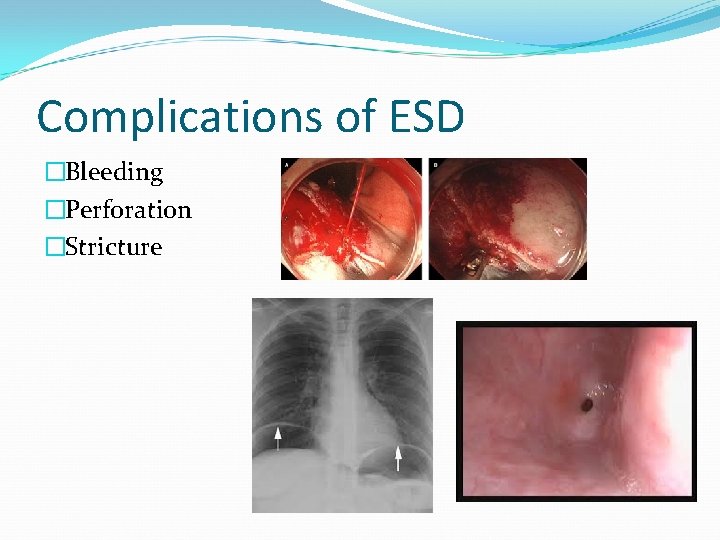 Complications of ESD �Bleeding �Perforation �Stricture 