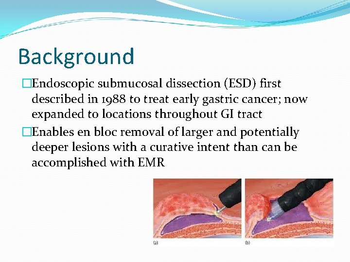 Background �Endoscopic submucosal dissection (ESD) first described in 1988 to treat early gastric cancer;