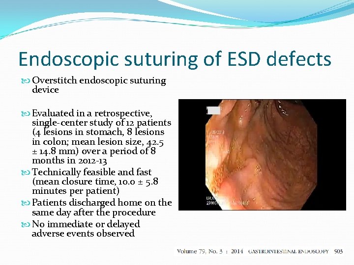 Endoscopic suturing of ESD defects Overstitch endoscopic suturing device Evaluated in a retrospective, single-center